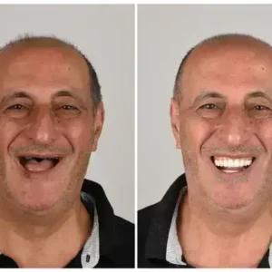 🦷 Denturelix™ Custom-Fit Functional Dentures 😁 Smile with Confidence