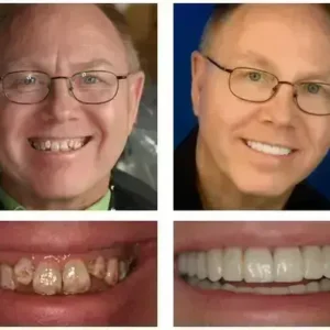 🦷 Denturelix™ Custom-Fit Functional Dentures 😁 Smile with Confidence
