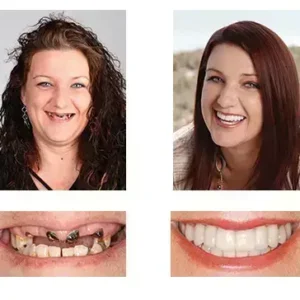 🦷 Denturelix™ Custom-Fit Functional Dentures 😁 Smile with Confidence