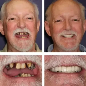 【Official Brand Store】BQYOOM™-Custom-Fit Functional Dentures — Combination pack