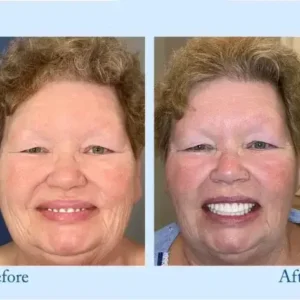 Hidone™ – Premium-Zahnprothese