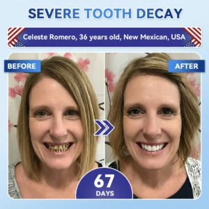 Your Smile~ NESLEMY® 🦷 Tideglusib Fast‑Dissolving Tooth & Gum Repair Oral Strips ✨ (𝟓-𝐢𝐧-𝟏 💎 𝐑𝐞𝐛𝐮𝐢𝐥𝐝 𝐄𝐧𝐚𝐦𝐞𝐥 & 𝐃𝐞𝐧𝐭𝐢𝐧 • 𝐒𝐭𝐫𝐞𝐧𝐠𝐭𝐡𝐞𝐧 𝐆𝐮𝐦𝐬 • 𝐄𝐫𝐚𝐝𝐢𝐜𝐚𝐭𝐞 𝐓𝐚𝐫𝐭𝐚𝐫 & 𝐎𝐝𝐨𝐫 • 𝐖𝐡𝐢𝐭𝐞𝐧𝐢𝐧𝐠 • 𝐒𝐭𝐨𝐩 𝐓𝐨𝐨𝐭𝐡 𝐒𝐞𝐧𝐬𝐢𝐭𝐢𝐯𝐢𝐭𝐲)