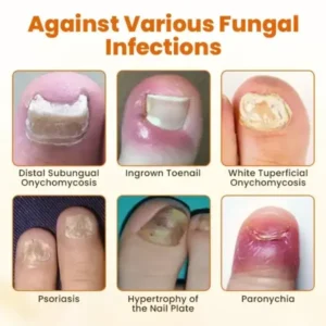 CVREOZ® FungiFix Bee Venom Nail Spray