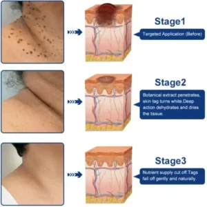 ✨😍Celsiora® Targeted Skin Tag & Wart Removal Cream – Time-Released Phyto-Exfoliant (12% Celandine ) & Bio-Active Terpene Viral-Inhibitor (8% Thuja)