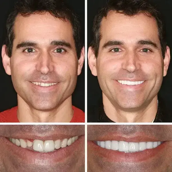 🌎Ends Today: 70% OFF! ⏰ Medical Full Denture with Strong Suctiond