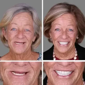 🌎Ends Today: 70% OFF! ⏰ Medical Full Denture with Strong Suctiond