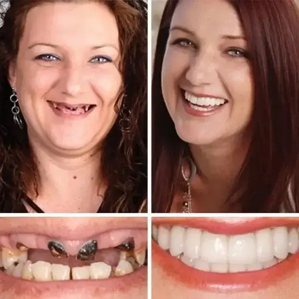 🌎Ends Today: 70% OFF! ⏰ Medical Full Denture with Strong Suctiond