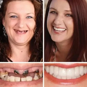 KLENIMORE™ Custom-Fit Dentures