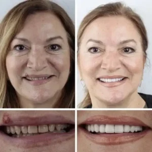 KLENIMORE™ Custom-Fit Dentures