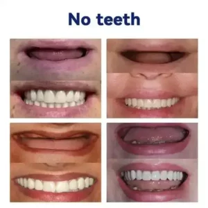 NESLEMY™ Advanced Customized Full Denture Set