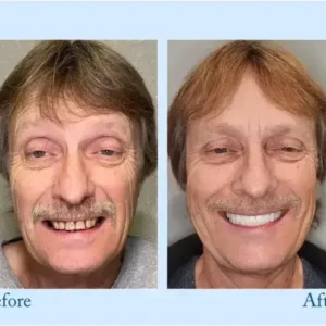 Smileasego™ – Premium-Zahnprothese