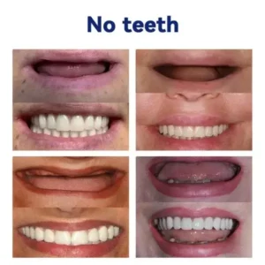Vaxflite™Advanced Full Denture Set