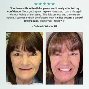 Yagoo™ Custom Custom-Fit Full Functional Dentures
